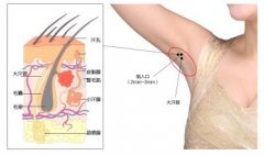 有腋臭不能多吃油腻食物吗